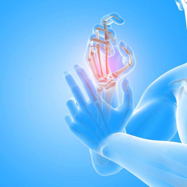 Arthritis treatment