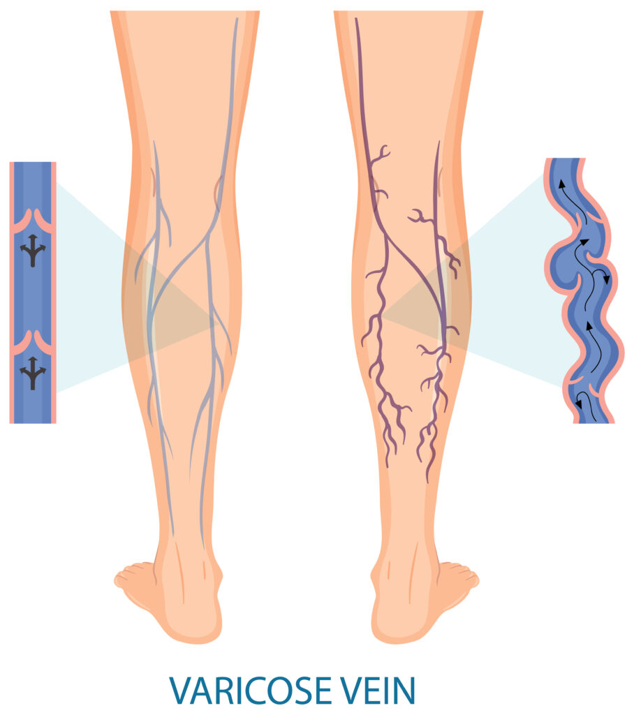 Varicose Vein treatment in hyderabad